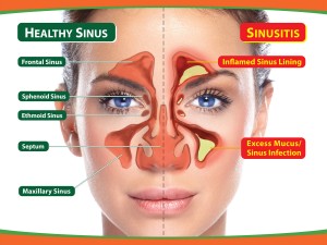 Chronic Sinusitis